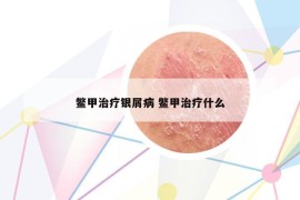 鳖甲治疗银屑病 鳖甲治疗什么