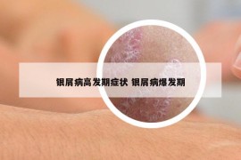 银屑病高发期症状 银屑病爆发期