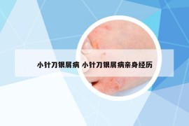 小针刀银屑病 小针刀银屑病亲身经历