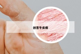 创意牛皮癣