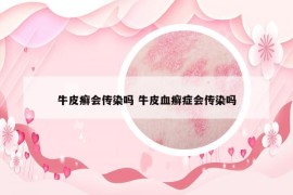 牛皮癣会传染吗 牛皮血癣症会传染吗