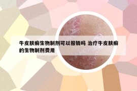 牛皮肤癣生物制剂可以报销吗 治疗牛皮肤癣的生物制剂费用