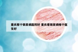 重庆那个银屑病医院好 重庆看银屑病哪个医生好