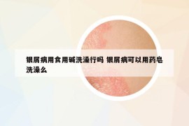 银屑病用食用碱洗澡行吗 银屑病可以用药皂洗澡么