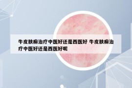 牛皮肤癣治疗中医好还是西医好 牛皮肤癣治疗中医好还是西医好呢