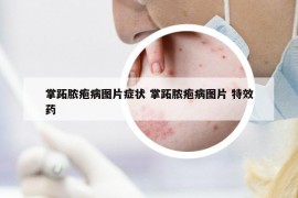 掌跖脓疱病图片症状 掌跖脓疱病图片 特效药