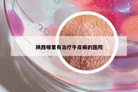 陕西哪里有治疗牛皮癣的医院