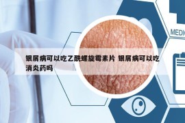 银屑病可以吃乙酰螺旋霉素片 银屑病可以吃消炎药吗