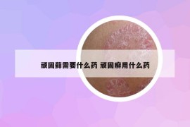 顽固藓需要什么药 顽固癣用什么药