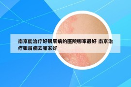 南京能治疗好银屑病的医院哪家最好 南京治疗银屑病去哪家好