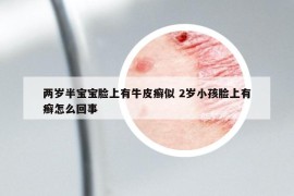 两岁半宝宝脸上有牛皮癣似 2岁小孩脸上有癣怎么回事