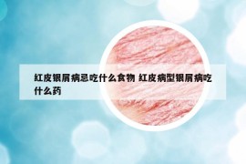 红皮银屑病忌吃什么食物 红皮病型银屑病吃什么药