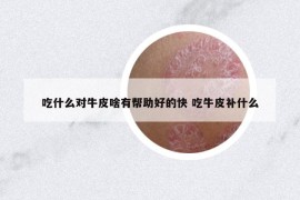 吃什么对牛皮啥有帮助好的快 吃牛皮补什么