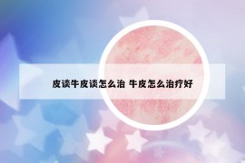 皮谈牛皮谈怎么治 牛皮怎么治疗好