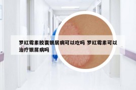 罗红霉素胶囊银屑病可以吃吗 罗红霉素可以治疗银屑病吗