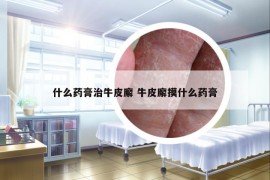 什么药膏治牛皮廨 牛皮廨摸什么药膏