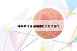 手癣如何治 手癣用什么方法治疗