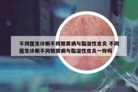 不同医生诊断不同银屑病与脂溢性皮炎 不同医生诊断不同银屑病与脂溢性皮炎一样吗