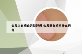 头发上有癣自己能好吗 头发里有癣用什么药膏