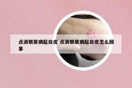 点滴银屑病起白皮 点滴银屑病起白皮怎么回事