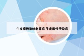 牛皮廨传染给老婆吗 牛皮廨性传染吗