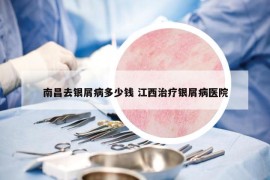 南昌去银屑病多少钱 江西治疗银屑病医院