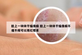 脸上一块块干燥像癣 脸上一块块干燥像癣不痛不痒可以用红霉素