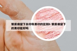 银屑病留下白印和黑印的区别6 银屑病留下的黑印能好吗