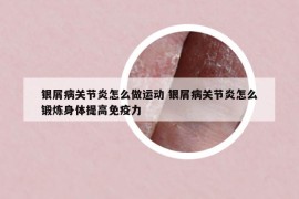 银屑病关节炎怎么做运动 银屑病关节炎怎么锻炼身体提高免疫力