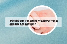 甲氨蝶呤能用于银屑病吗 甲氨蝶呤治疗银屑病需要联合其他药物吗?