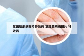 掌跖脓疱病图片特效药 掌跖脓疱病图片 特效药