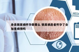 身患银屑病怀孕敢要么 银屑病患者怀孕了会加重病情吗