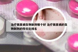 治疗银屑病生物制剂哪个好 治疗银屑病的生物制剂的性价比排名