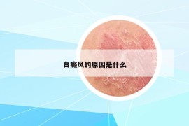 白癜风的原因是什么