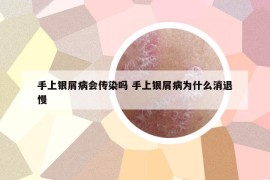 手上银屑病会传染吗 手上银屑病为什么消退慢