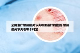 全国治疗银屑病关节炎哪里最好的医院 银屑病关节炎看哪个科室