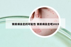 银屑病自愈的可能性 银屑病自愈吧2019