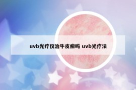 uvb光疗仪治牛皮癣吗 uvb光疗法