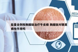 能量合剂和胸腺肽治疗牛皮癣 胸腺肽对银屑病有作用吗