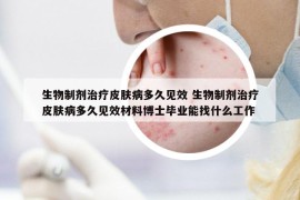 生物制剂治疗皮肤病多久见效 生物制剂治疗皮肤病多久见效材料博士毕业能找什么工作