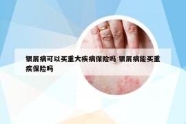 银屑病可以买重大疾病保险吗 银屑病能买重疾保险吗