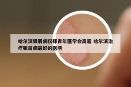 哈尔滨银屑病仅择青年医学会高超 哈尔滨治疗银屑病最好的医院