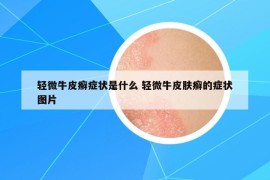 轻微牛皮癣症状是什么 轻微牛皮肤癣的症状图片