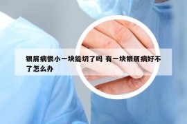 银屑病很小一块能切了吗 有一块银屑病好不了怎么办