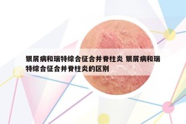 银屑病和瑞特综合征合并脊柱炎 银屑病和瑞特综合征合并脊柱炎的区别