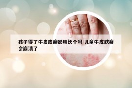 孩子得了牛皮皮癣影响长个吗 儿童牛皮肤癣会崩溃了