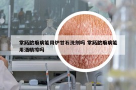 掌跖脓疱病能用炉甘石洗剂吗 掌跖脓疱病能用酒精擦吗