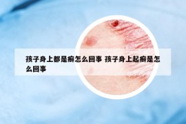 孩子身上都是癣怎么回事 孩子身上起癣是怎么回事