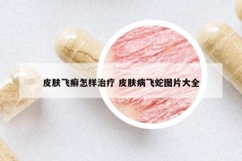 皮肤飞癣怎样治疗 皮肤病飞蛇图片大全