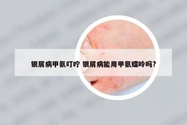 银屑病甲氨叮咛 银屑病能用甲氨蝶呤吗?